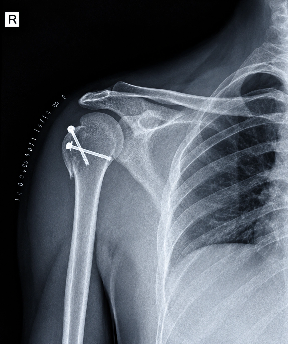 Failed Screw Fixation Before Surgery